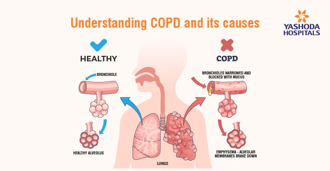 COPD hastalarında yaşam süresi ve hayati önemde 2026 rehberi [Uzman İpuçları]